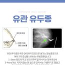 유방 결절 원인 5가지 및 치료 : 가슴 멍울(몽우리) 낭종(물혹 혹) 섬유선종(양성종양) 유두종 지방종 이미지