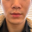 네오 | 광주 탄력 리프팅 관리 네오스컬프 솔직후기