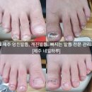 문제성 손발톱 전문관리 케어톱톱