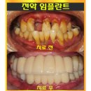 [아산 허브치과] 전악 임플란트 치료후기