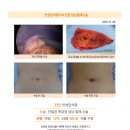 만성담석증수술후기. 건강검진 중 발견한 담낭내 잔여물. 덜컥 겁이 나 어느 병원이 좋을지 찾는 도중 김정윤 원장님을... 이미지