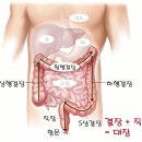 직장암 수술 후 배변 습관의 변화 및 치료 이미지