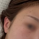 강남영도한의원 | 편평사마귀 제거 후기 (거우침 1일차~7일차 변화, 가격, 관리법)