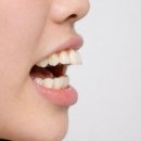이석기의미치과의원 | 당산동치과 추천, 개방교합 교정 후기? 과정? 기간? 이 글 하나에 담았습니다