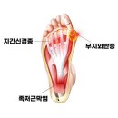 아치날 | 신발 아치 깔창 평발 장시간 근무자의 3개월 사용후기