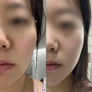 서울 마곡 에스테틱 피부에봄 | 브이라인관리 받은 100% 솔직 후기