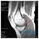 반월상 연골손상 - 관절내시경수술 이미지