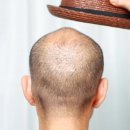 “모자 쓰면 머리카락 더 빠진다?”… 잘못된 탈모 상식 3 [팩트진찰대] 이미지