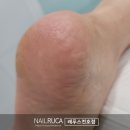 서울 강동 발관리샵, 레푸스 굳은살 제거 후기