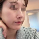 성옥빌딩(인자부동산) | 신논현역 피부과에서 받은 쥬베룩볼륨과 자가혈 줄기세포 주사 후기