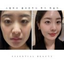 달아래행복 | 옆볼필러 대신 스컬트라 콜라겐주사 한달차 후기
