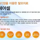 성남시, 부천시 탈모 괴물같은 치료방법으로 시작 ~! 이미지