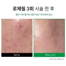 이화그린약국 | 대구 달서구 여드름 피부관리, 모공 속까지 케어하는 로제필 필링