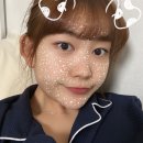 신흥수지 | 수지 눈 점 제거 결막모반 레이저 제거 후기 • 비용