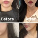 클레시스 | [홍대피부과추천]티타늄신버전 포트라리프팅 내돈내산후기