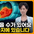 대장암은 운이 아닙니다. 90%는 막을 수 있는 암입니다 이미지