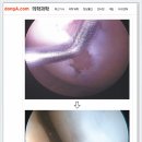 줄기세포로 손상된 연골 재생시킨다(선정형외과)-동아일보 이미지