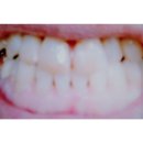 오복광택 | 범랑질 복구제. 에나멜복구제 판매중