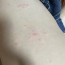 메디필피부과의원 | [공지] 20대 대상포진.. 피부염이 아니었자나!! | DB손해보험 실비청구 ; 내인생 첫 실비.. | 한달 후...