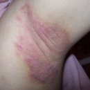 Atopy on Armpits (Pictures) 이미지