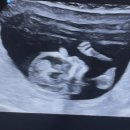 서초하나산부인과의원 | 니프티(녹십자 지니프티) 검사 병원 후기 (서초하나산부인과 성공, 서울의료원 실패), 12주차 니프티...