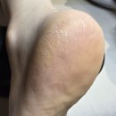 김하연헤어 | 파주 야당 겨울철 발 뒤꿈치 패디플래닝으로 걱정 끝 [ 탠블리 왁싱&패디플래닝 야당점 ]
