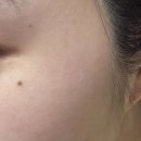 애오개약국 | [아현동 피부과] 컨실러로 가리기 바빴던 흑자 레이저 후기