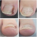 강동이엠365의원 | 아이 내성발톱 치료기_강동이엠365의원 내성발톱 클리닉