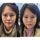 에스삼성성형외과의원 | [내돈내산] 군산 텐쎄라 600라인 2개월 후기 ｜가격·통증·효과 솔직 리뷰