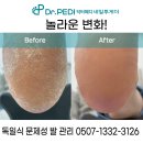 파주 금촌 발각질 관리, 닥터페디&amp;네일투게더에서 편안하게