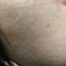 평택외과의원 | 평택리쥬란아이 후기 보면 갈립니다, 효과·엠보 지속과 가격 차이