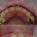 이원치과기공소 | 앞니 모두 충치 치료 지르코니아 크라운, 이것은 충치치료인가 심미치료인가 6전치가 아닌 12전치 크라운