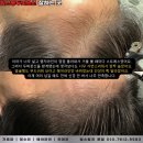 밀스칼프 이미지