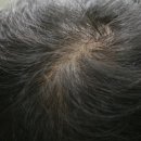 제명한의원 | 여자 대학생 정수리탈모 19주차 치료후기