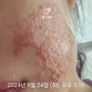 산성바른한의원 | 지루성 피부염 한의원 셀파젤 액트 연고 비교 후기