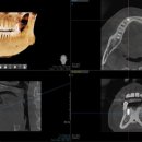 인플란트치과의원 | 오리역 임플란트 치과 리볼리치과의원 방문 후기 믿고 다니는 치과에서 임플란트까지 진행한 후기