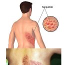 대상포진 초기 증상에 대해 알아보았어요♪ 이미지