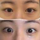 멍 | 눈밑지방재배치 발산피부과 당일-일주일-2주 찐 후기 (멍, 붓기)