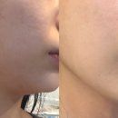 PURO뷰티토탈전문샵 | 서면에스테틱 퓨로뷰티토탈전문샵, 하이푸로 턱선 끌어올린 리얼후기