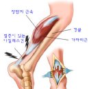 "아킬레스 건 파열'' 이미지