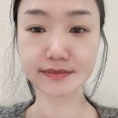 삼한사우나 | 힐로웨이브 콜라겐주사 부산 서면 피부과 중안부 볼륨 만족 후기