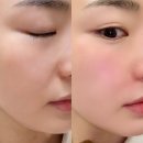 팔자 콜라겐 주사 강남 언주 피부과 앞볼콜라겐주사 내돈내산 후기