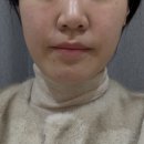 리즌뷰티 | 시술후기] 속건조 해결을 위한 선택, 바이리즌 스킨부스터 솔직 후기 (통증, 일주일 경과, 주의사항)-1회차