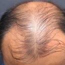 월랑초등학교 | 천안아산탈모병원, 50대 남성 유전성 탈모치료 6개월차 솔직 후기