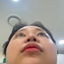 (주)재미코 | 천호역피부과 코실리프팅 낮은코 콧대 테스코 후기