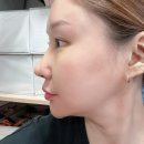 자연에서 얻은 참다운 삶 | [코보형물 전체제거 후기]부목제거부터 1달경과 - 후기7탄