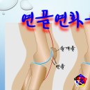 사암침, 사암침법 - 연골연화증 치료 방법 - 비과학적 양의학 106 이미지