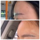 잠실새내역피부과 벨로테로 이마필러 일주일 리얼 후기(붓기, 통증)