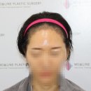 로즈앤성형외과의원 | ③ 수술 후 5개월차_안면거상 전문 원장님도 추전하는 모앤라인, 40대 여성 모발이식 리얼 후기