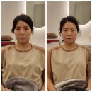 압구정마사지 추천 : 독일테라피_결혼 2일 전 승모관리 후기